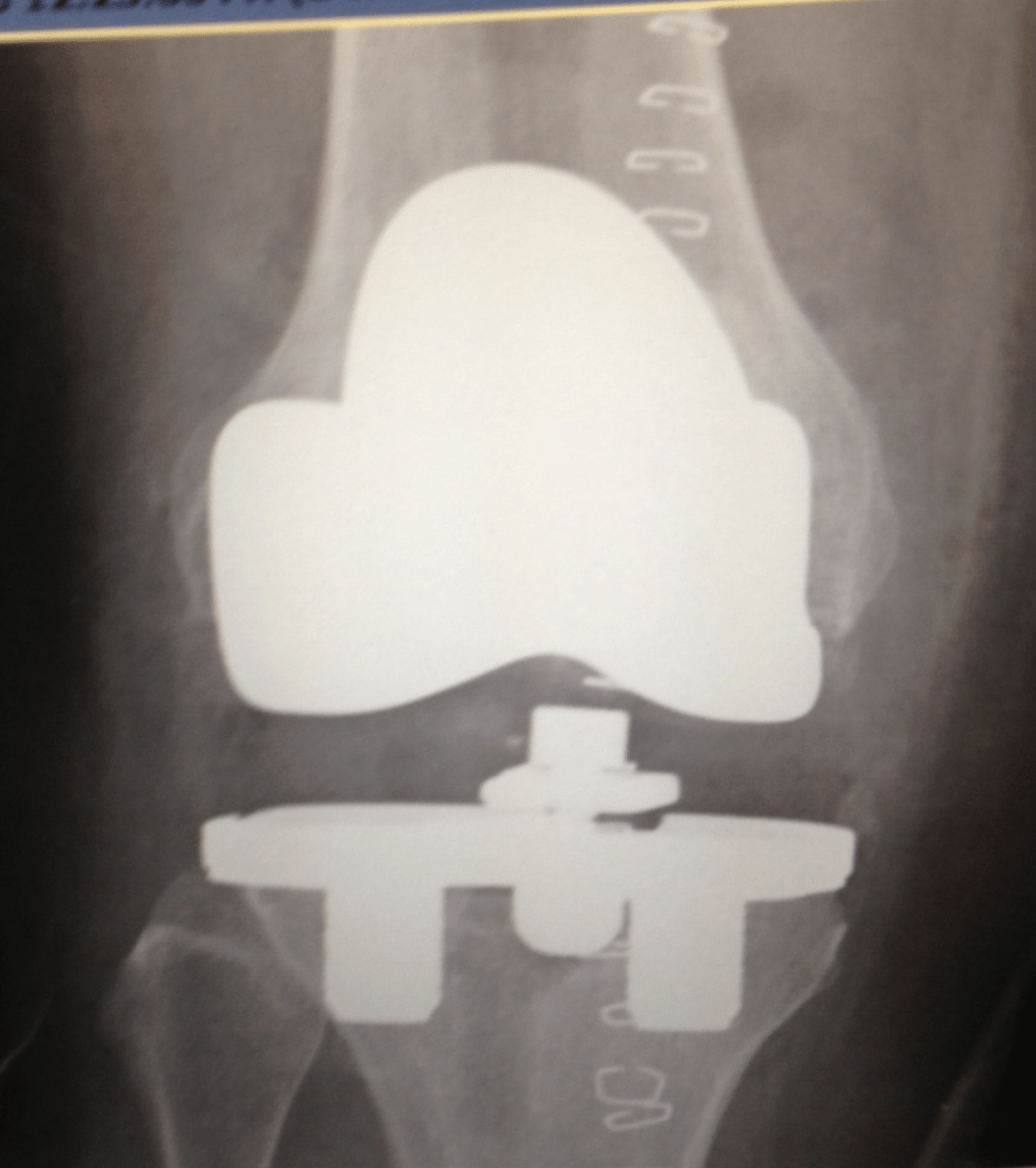 Zimmer NexGen CR (Implant 1407073)